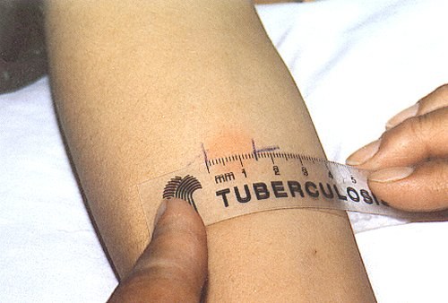 Как выявить туберкулез