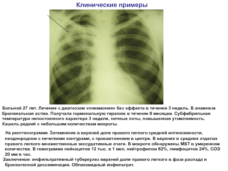 Пневмония верхней доли легкого. Рентген грудной клетки бронхиальная астма. Рентгенография легких при бронхиальной астме. Рентгенография при бронхиальной астме заключение. Рентген легких при бронхиальной астме.