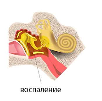 Острый евстахиит. Евстахиева труба в горле. Евстахиит острый и хронический. Евстахиит (воспалительный процесс в слуховой трубе).