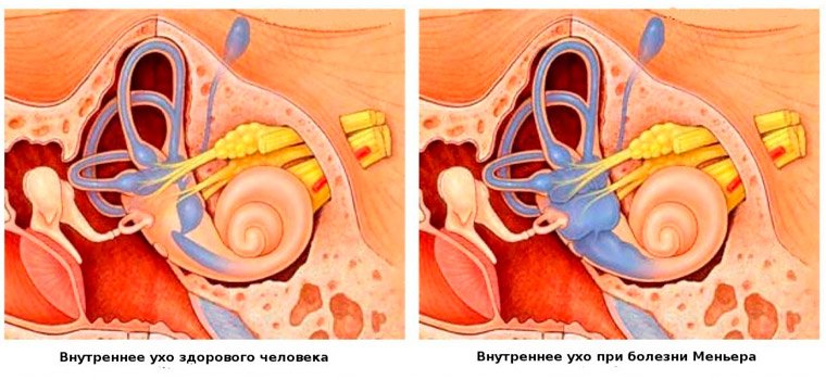 Внутреннее ухо при болезни Мейнера