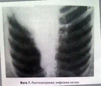 Эмфизема на рентгенограмме