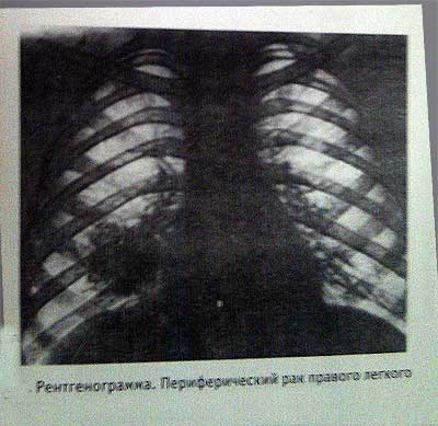 Рентгенограмма рак легкого