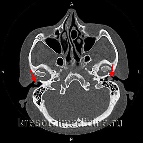 КТ височных костей. Серные пробки в наружных слуховых каналах с обеих сторон