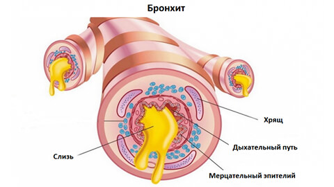 бронхит