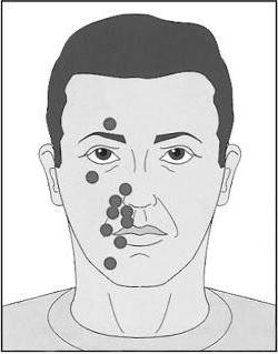воспаление тройничного нерва на лице