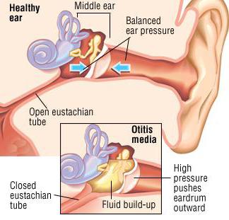 отит среднего уха лечение