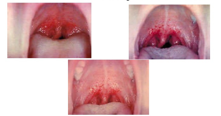 Инфекционная болезнь горла