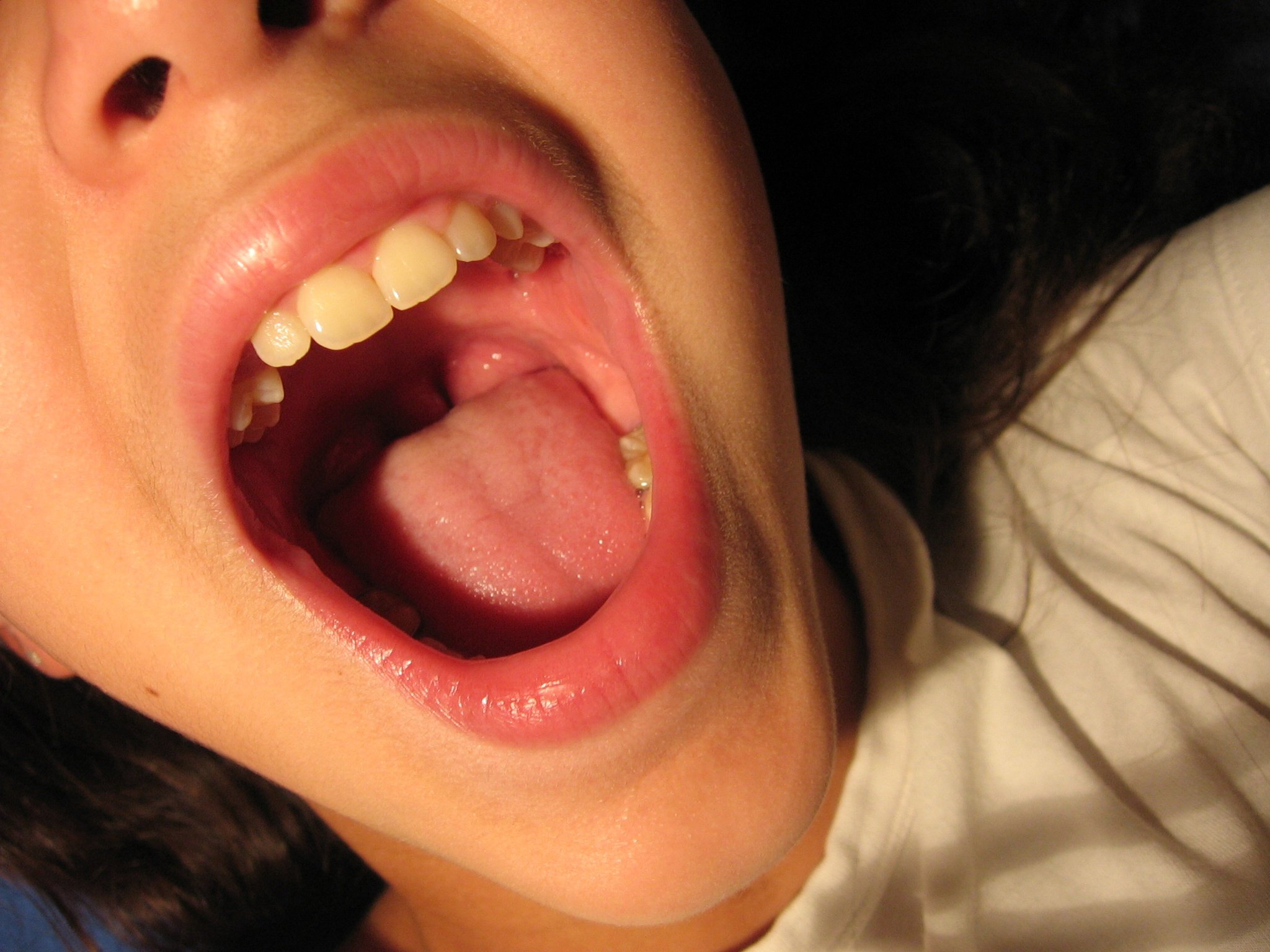 Болит небо во рту: причины и лечение