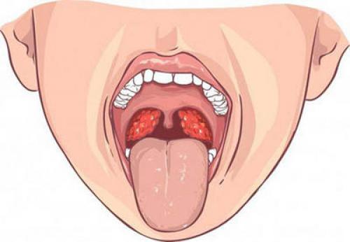 Першит в горле кашель ночью. Першение в горле и кашель — причины появления