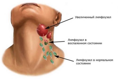 Лимфоузел на шее чем лечить. Какой врач назначает терапию? 02